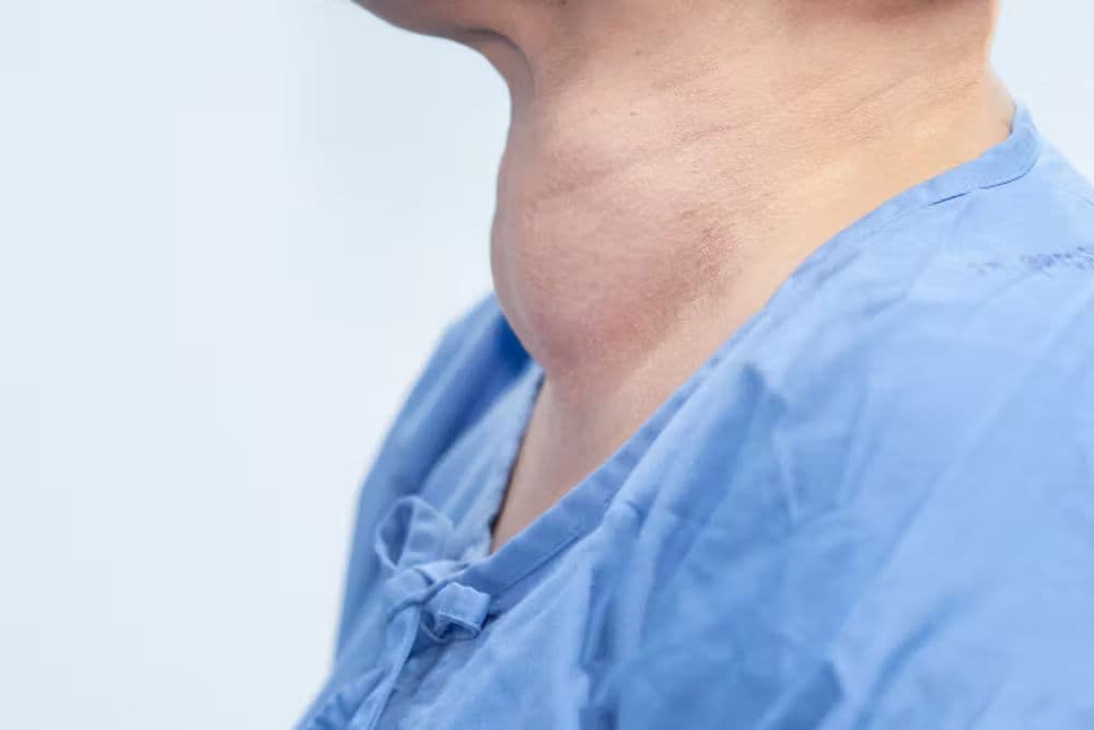 Illustration of the thyroid gland under autoimmune attack