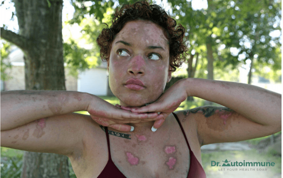 How Autoimmune Diseases Can Affect Your Skin