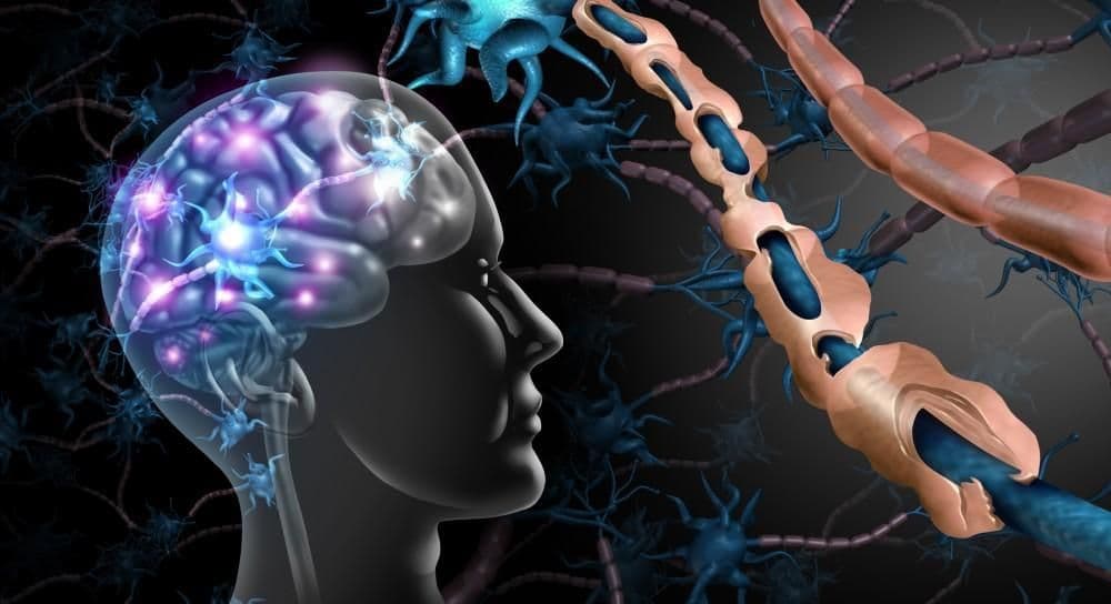 Illustration of nerve damage caused by multiple sclerosis