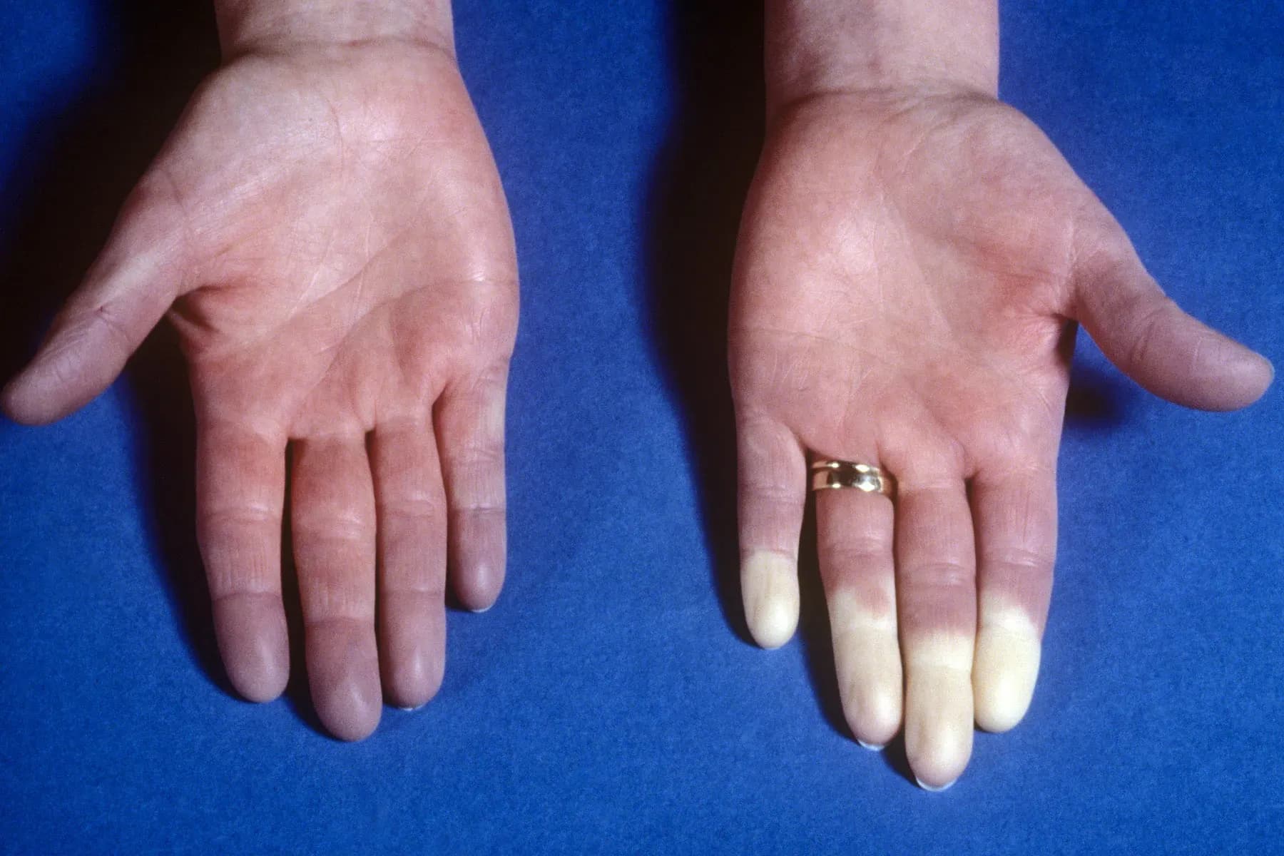 Fingers affected by Raynaud's phenomenon turning pale from cold exposure