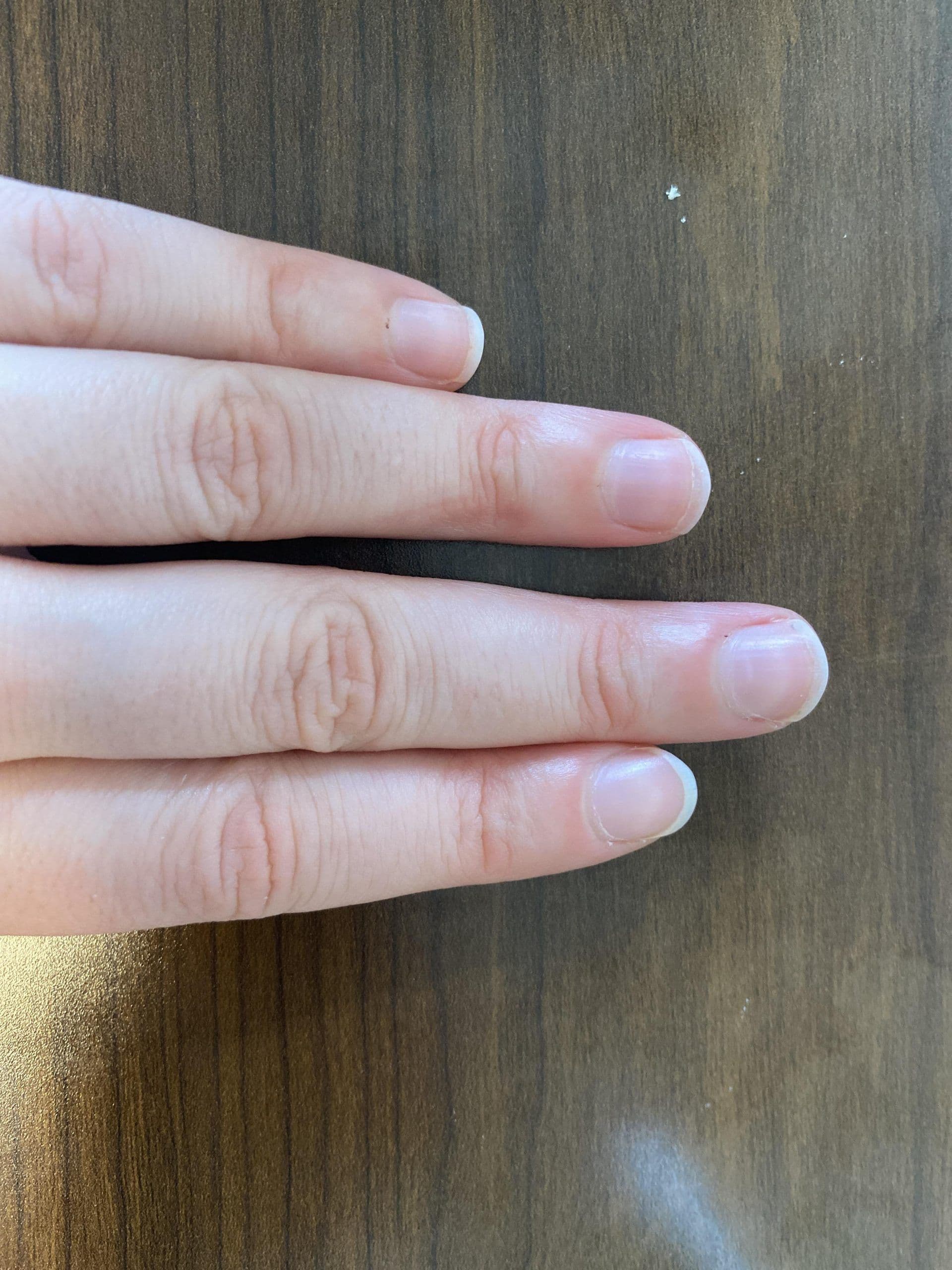 Person with cold, discolored fingers due to Raynaud's phenomenon
