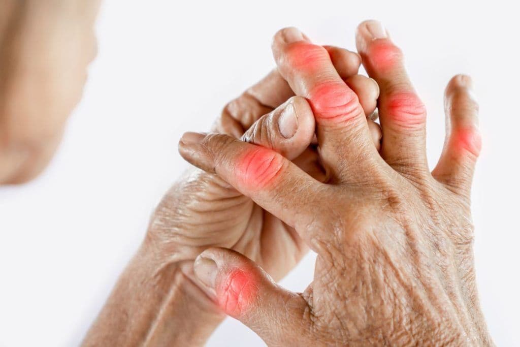 Illustration comparing a healthy joint to one affected by rheumatoid arthritis