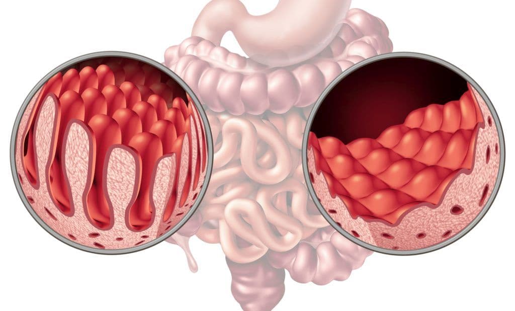Illustration comparing healthy intestinal villi on the left with damaged or atrophied villi on the right