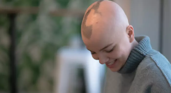 Alopecia-doctor-balding-treatment-boulder