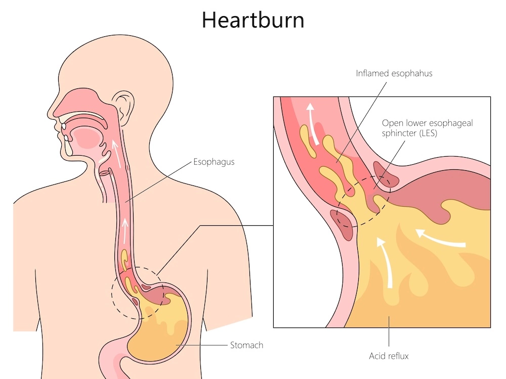 acid reflux